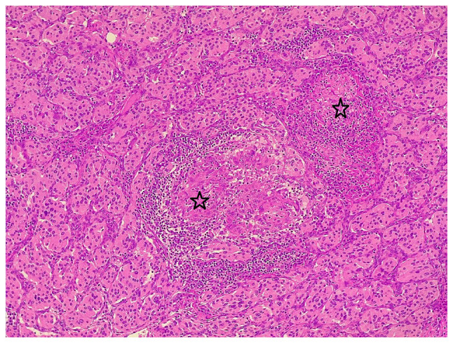 Sarcoid‑like granulomatous inflammation in a carotid body paraganglioma: A case report and mini‑review of the literature.