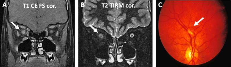 Neuropsychiatric involvement in juvenile-onset systemic lupus erythematosus (jSLE).