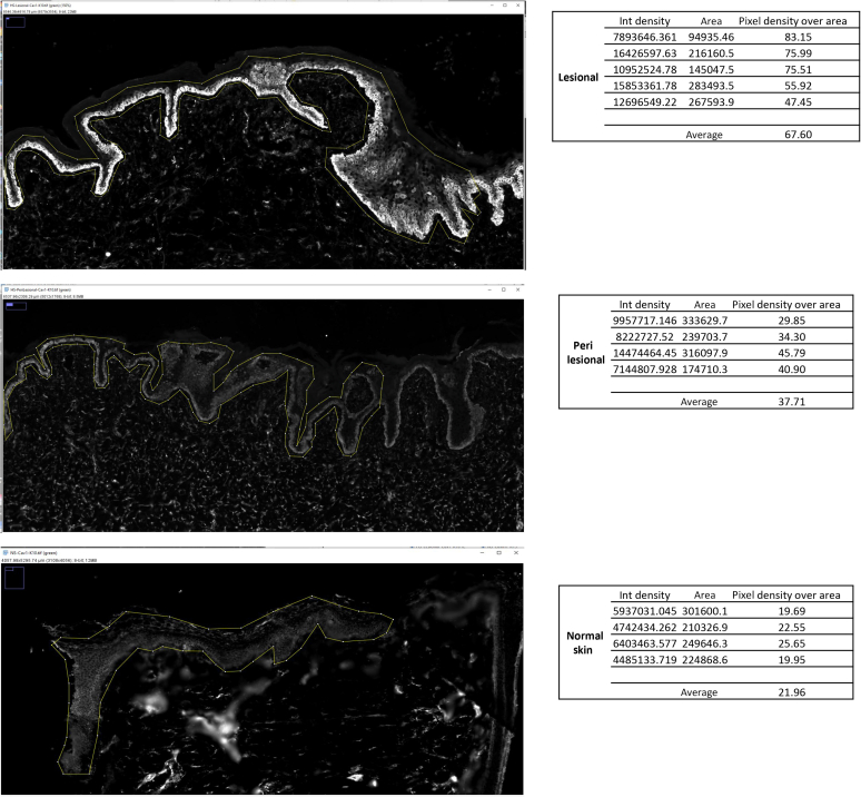 Upregulation of Caveolae-Associated Proteins in Lesional Samples of Hidradenitis Suppurativa: A Case Series Study