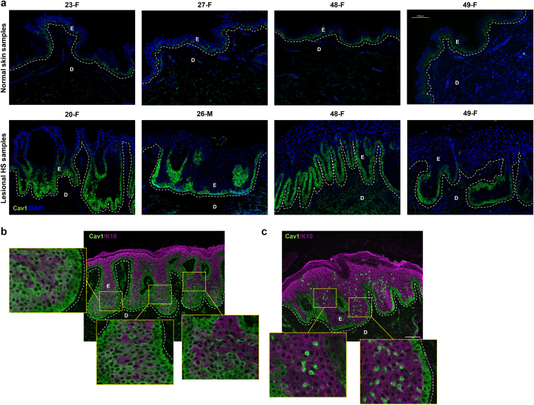 Upregulation of Caveolae-Associated Proteins in Lesional Samples of Hidradenitis Suppurativa: A Case Series Study