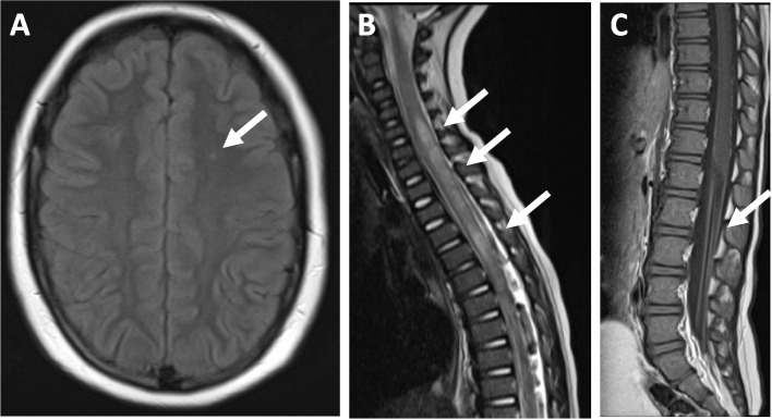 Neuropsychiatric involvement in juvenile-onset systemic lupus erythematosus (jSLE).