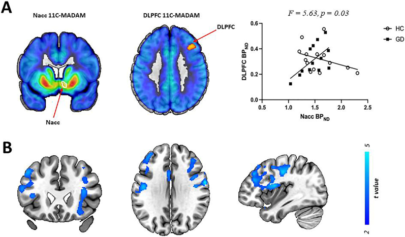 Abnormal frontostriatal connectivity and serotonin function in gambling disorder: A preliminary exploratory study.