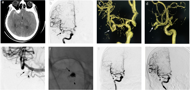 Mechanical compression management of the right middle cerebral artery inferior trunk using a stent during coil embolization of middle cerebral artery aneurysms: A case report and literature review