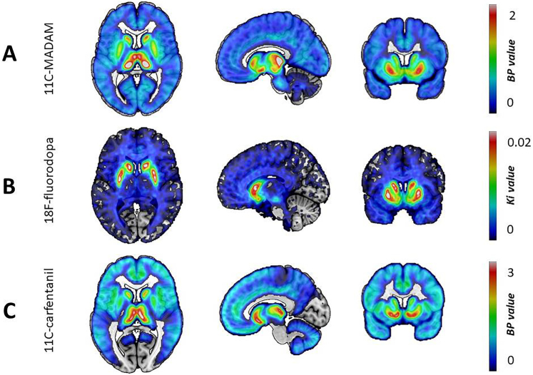 Abnormal frontostriatal connectivity and serotonin function in gambling disorder: A preliminary exploratory study.