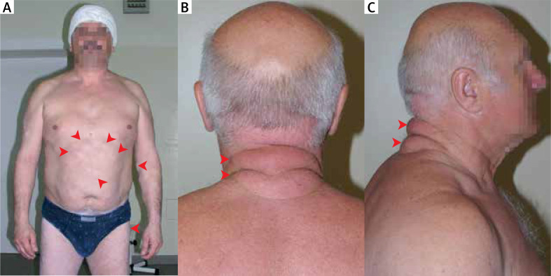 Lipomas: genetic basis of common skin lesions and their occurrence in rare diseases.