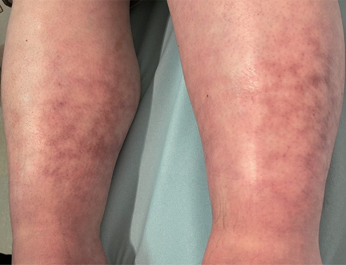 Clinical Image: Erythema ab igne: a mimicker of rheumatoid vasculitis.