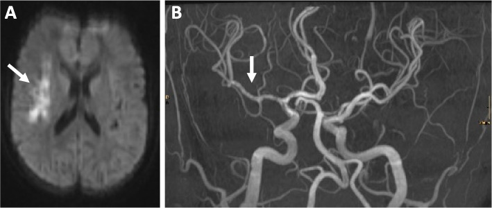 Neuropsychiatric involvement in juvenile-onset systemic lupus erythematosus (jSLE).