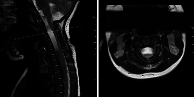 Pediatric intraspinal arachnoid cyst: successful endoscopic fenestration. Illustrative case.