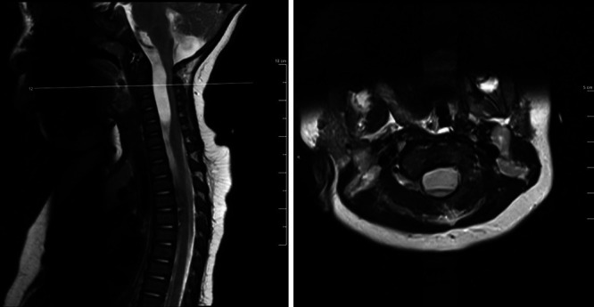Pediatric intraspinal arachnoid cyst: successful endoscopic fenestration. Illustrative case.