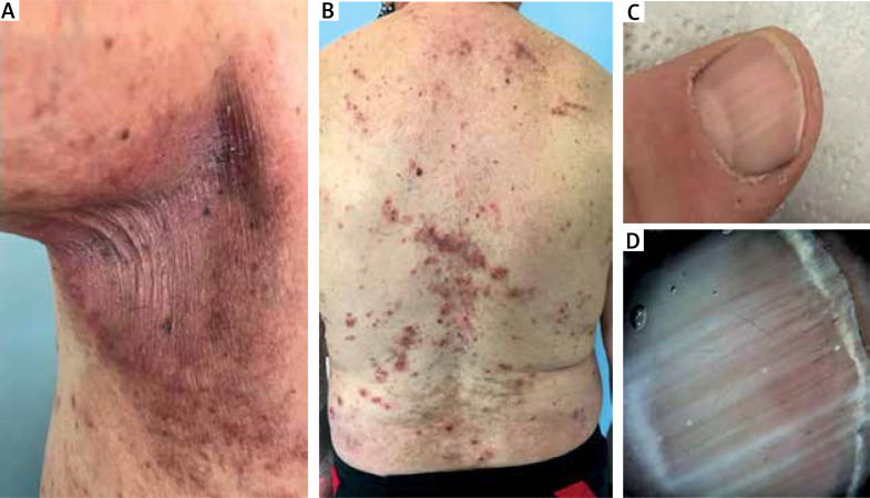 Hailey-Hailey disease exacerbated by scabies: the role of dermatoscopy in preventing misdiagnosis.