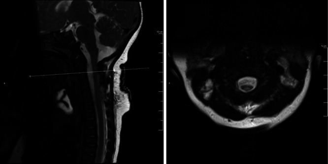 Pediatric intraspinal arachnoid cyst: successful endoscopic fenestration. Illustrative case.
