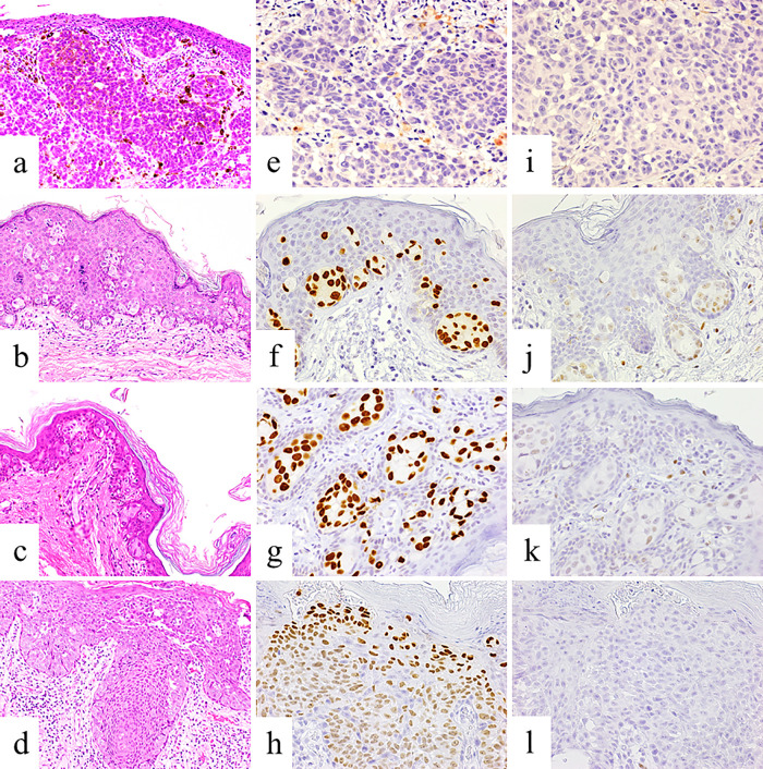 A clinicopathological analysis of forkhead box A1 (FOXA1) and estrogen receptor alpha expression in extramammary Paget's disease.