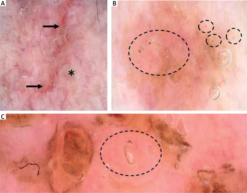 Hailey-Hailey disease exacerbated by scabies: the role of dermatoscopy in preventing misdiagnosis.