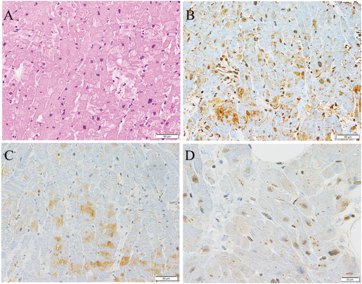 Ubiquitin, p62, and Microtubule-Associated Protein 1 Light Chain 3 in Cardiomyopathy.