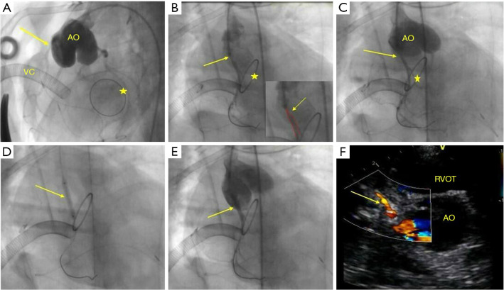 Percutaneous coronary stent implantation in children and young infants following surgical repair of congenital heart disease.