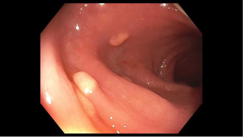 Pediatric Colonic Xanthomas, a Previously Unreported Colonoscopic Finding.