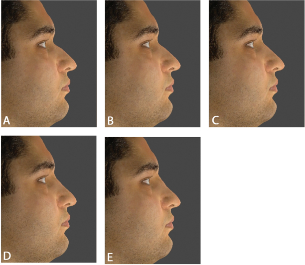 Ideal Nasal Preferences: A Quantitative Investigation with 3D Imaging in the Iranian Population.