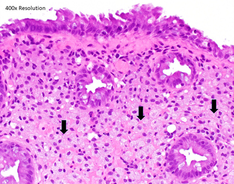 Pediatric Colonic Xanthomas, a Previously Unreported Colonoscopic Finding.