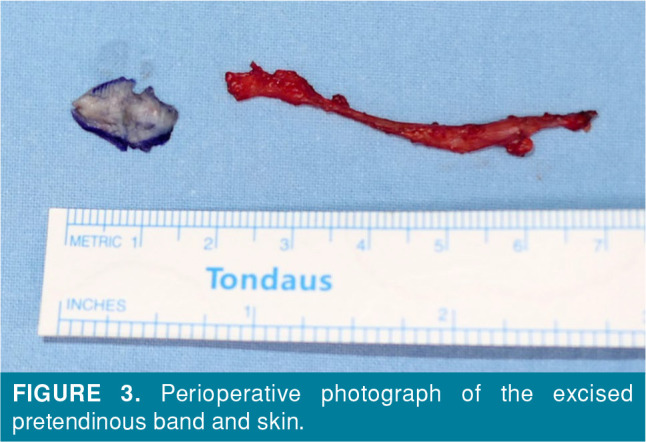 Dupuytren contracture after acute traumatic hand injury in an adolescent: A case report.