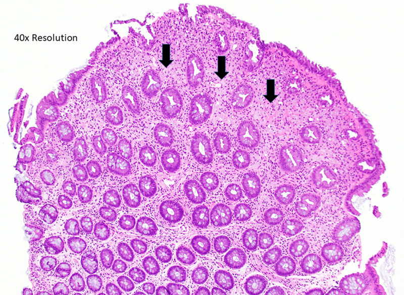 Pediatric Colonic Xanthomas, a Previously Unreported Colonoscopic Finding.