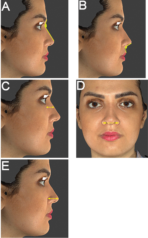 Ideal Nasal Preferences: A Quantitative Investigation with 3D Imaging in the Iranian Population.