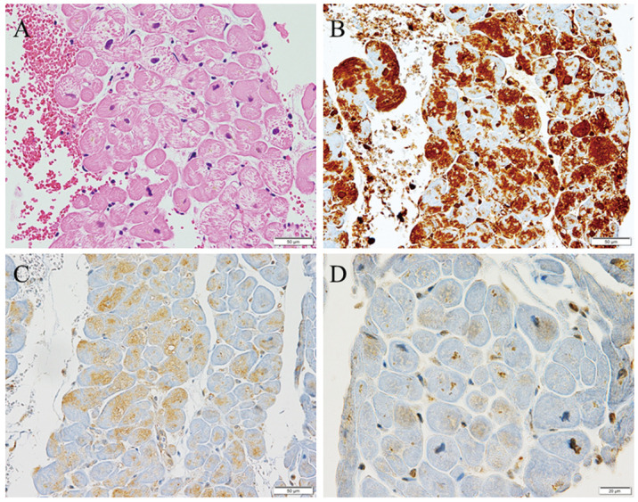 Ubiquitin, p62, and Microtubule-Associated Protein 1 Light Chain 3 in Cardiomyopathy.