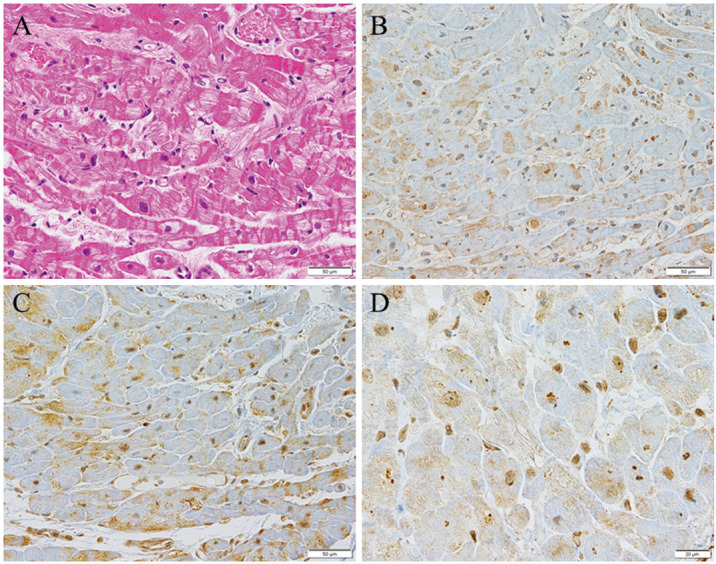 Ubiquitin, p62, and Microtubule-Associated Protein 1 Light Chain 3 in Cardiomyopathy.