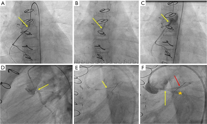 Percutaneous coronary stent implantation in children and young infants following surgical repair of congenital heart disease.