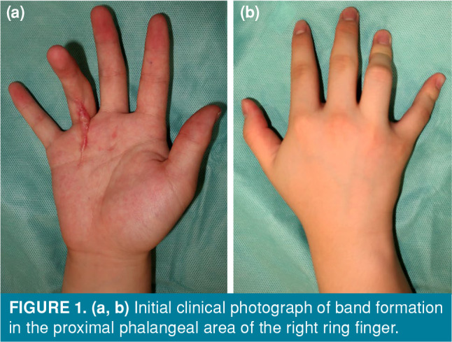 Dupuytren contracture after acute traumatic hand injury in an adolescent: A case report.