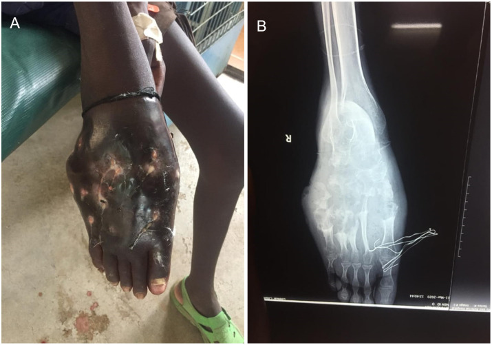 First report on mycetoma in Turkana County-North-western Kenya.