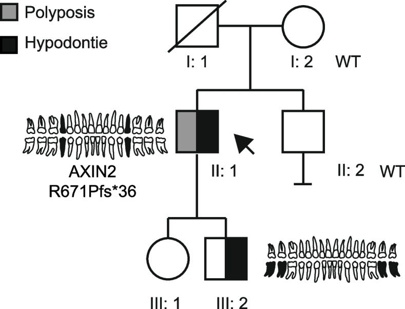 A novel pathogenic frameshift variant in AXIN2 in a man with polyposis and hypodontia.