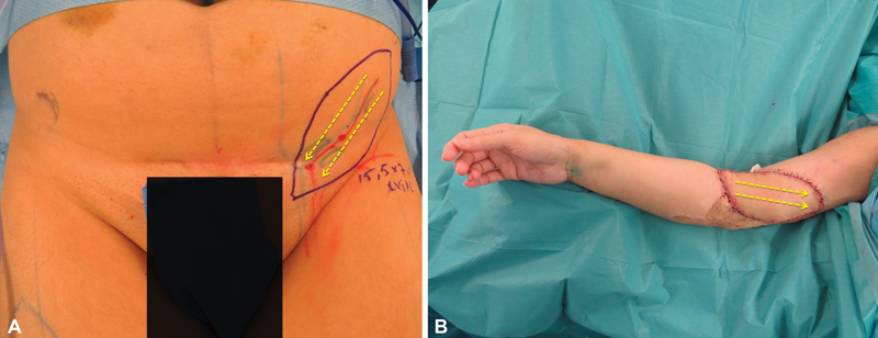 A Comprehensive Approach to Posttraumatic Lymphedema Surgical Treatment.