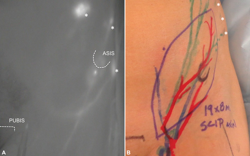 A Comprehensive Approach to Posttraumatic Lymphedema Surgical Treatment.