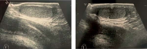 [Prepubertal gynecomastia at the debut of hereditary tumors predisposition syndrome (clinical case reports)].