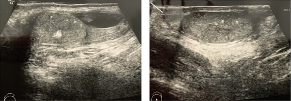 [Prepubertal gynecomastia at the debut of hereditary tumors predisposition syndrome (clinical case reports)].