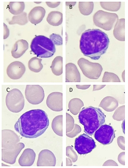 “Rod-Like” Cytoplasmic Crystals of Peripheral Lymphocytes in Chronic Lymphocytic Leukemia