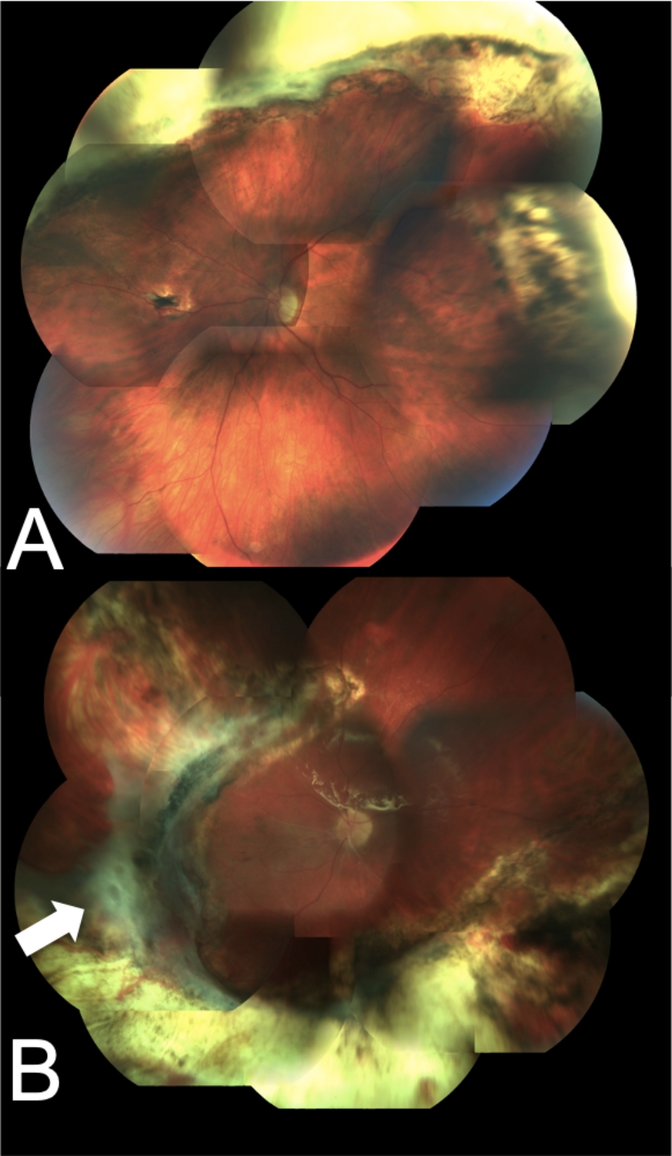 Long-term functional and structural outcomes after large chorioretinectomy for ruptured globe following blunt trauma.