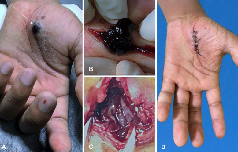 Management of traumatic superficial palmar arch pseudoaneurysm: a therapeutic challenge.