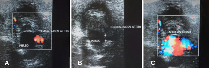 Management of traumatic superficial palmar arch pseudoaneurysm: a therapeutic challenge.