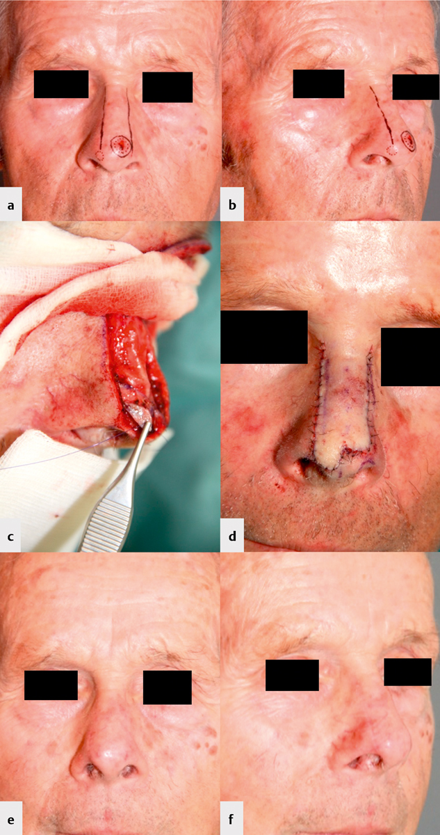 [Cosmetic outcome of nasal tip reconstruction with the frontonasal flap and other locoregional flaps - Cosmetic Outcome of Nasal Tip Reconstruction].