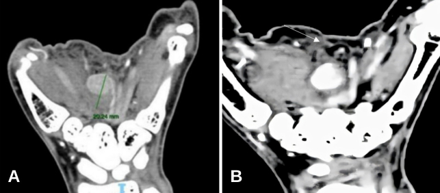 Management of traumatic superficial palmar arch pseudoaneurysm: a therapeutic challenge.