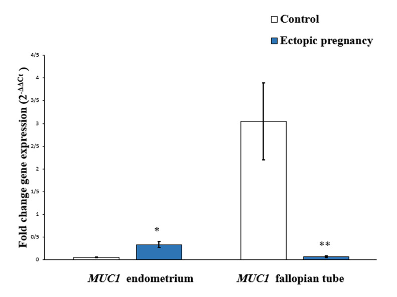 The Effect of Altered <i>Mucin1, FGF2,</i> and <i>HBEGF</i> Gene Expression at The Ectopic Implantation Site and Endometrial Tissues in The Tubal Pregnancy Pathogenesis: A Case-Control Study.