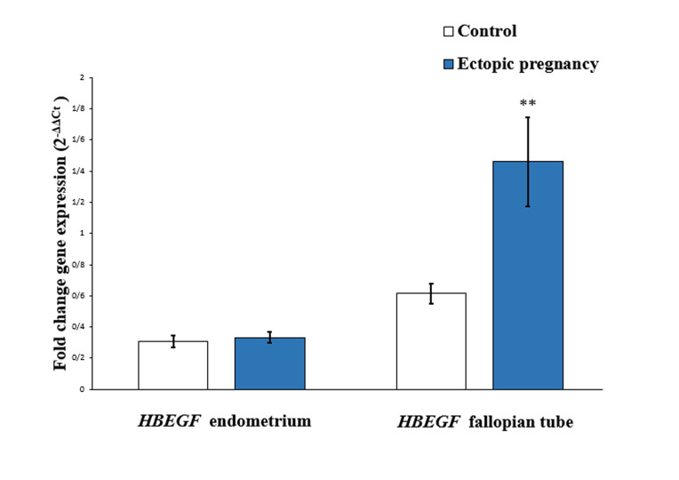 The Effect of Altered <i>Mucin1, FGF2,</i> and <i>HBEGF</i> Gene Expression at The Ectopic Implantation Site and Endometrial Tissues in The Tubal Pregnancy Pathogenesis: A Case-Control Study.