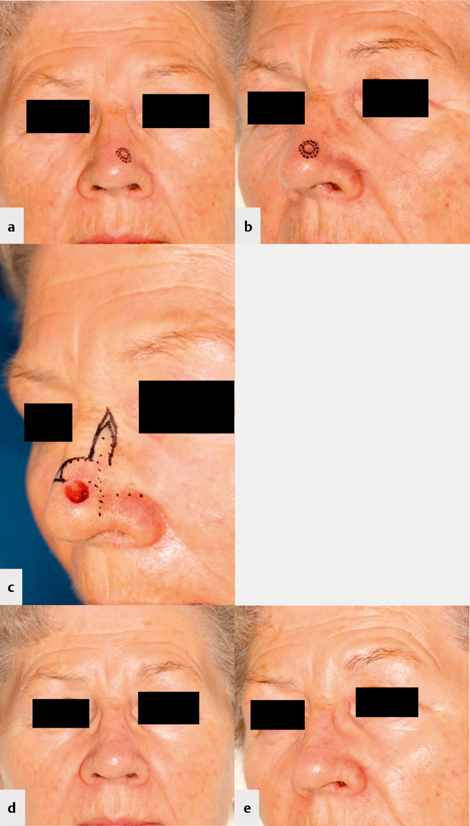 [Cosmetic outcome of nasal tip reconstruction with the frontonasal flap and other locoregional flaps - Cosmetic Outcome of Nasal Tip Reconstruction].