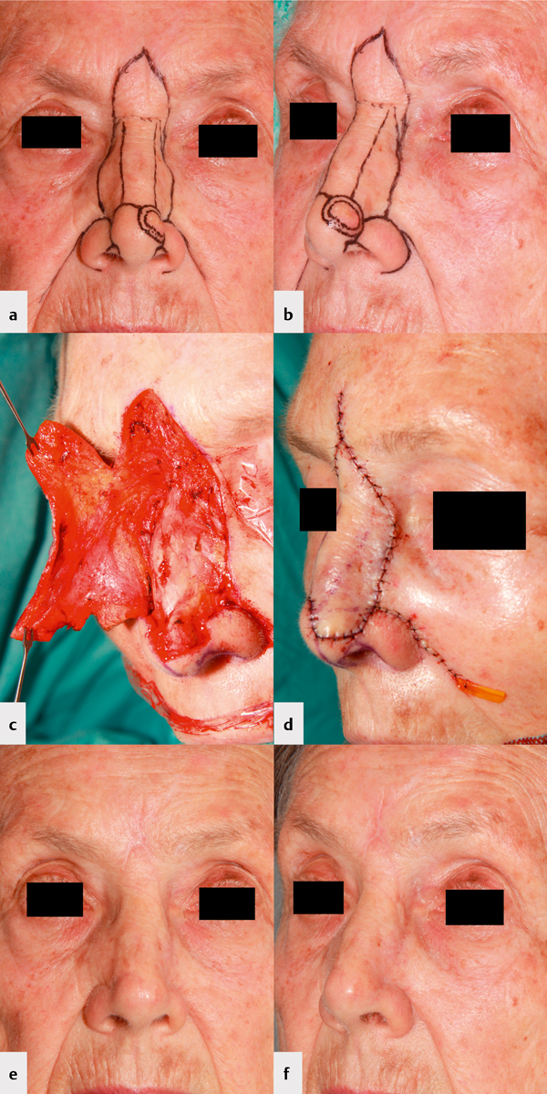 [Cosmetic outcome of nasal tip reconstruction with the frontonasal flap and other locoregional flaps - Cosmetic Outcome of Nasal Tip Reconstruction].