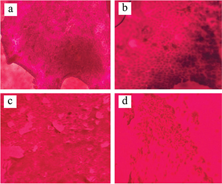 Conjunctival Impression Cytology and Tear Film Changes in Sarcoidosis: A Subjective and Objective Diagnosis Study.