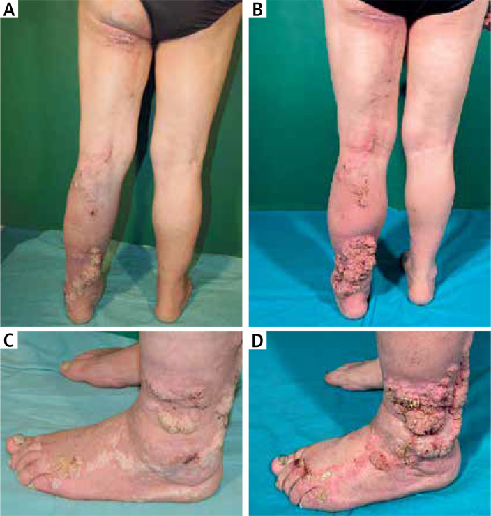 Giant inflammatory linear verrucous epidermal nevus: difficulties in the management.