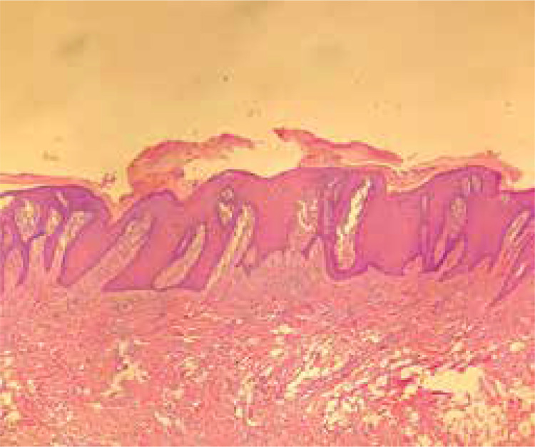 Giant inflammatory linear verrucous epidermal nevus: difficulties in the management.