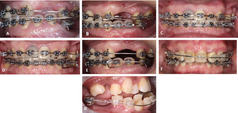 Ridge mini-implants, a versatile biomechanical anchorage device whose success is significantly enhanced by splinting: a clinical report.