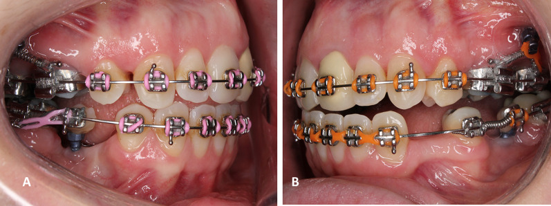 Ridge mini-implants, a versatile biomechanical anchorage device whose success is significantly enhanced by splinting: a clinical report.